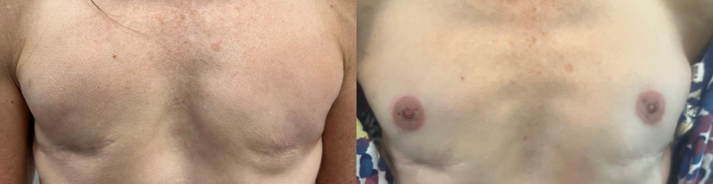 Before & After 3D Areola Tattooing Case 21 Front View in Denver, Colorado