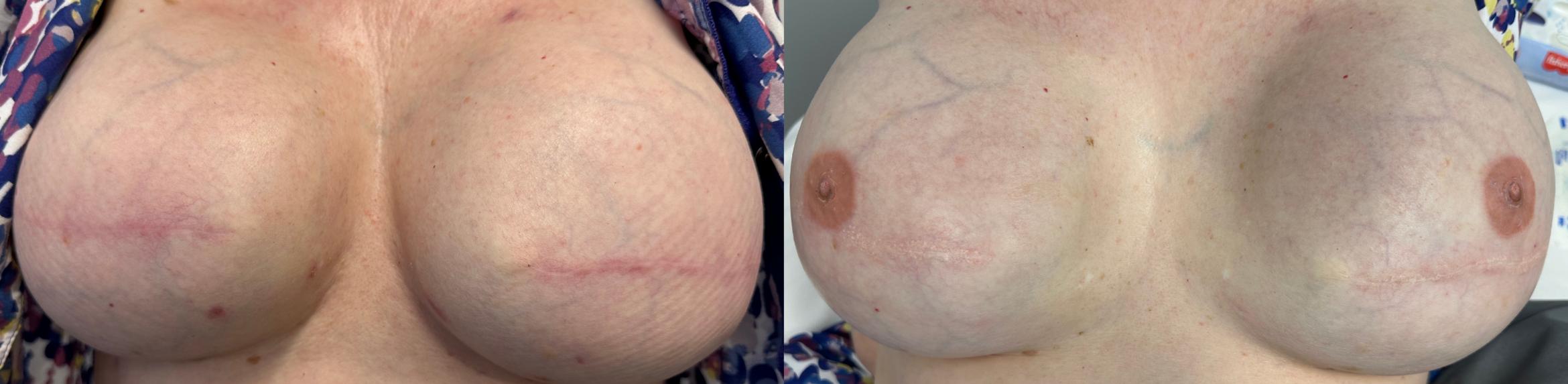 Before & After 3D Areola Tattooing Case 26 Left Side View in Denver, Colorado