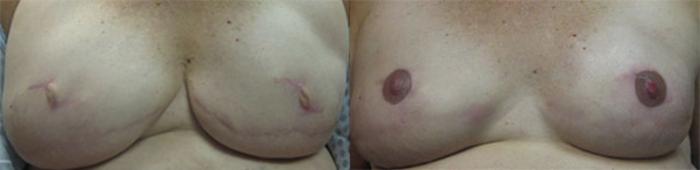 Before & After Scar Camouflage Tattooing Case 9 Front View in Denver, Colorado