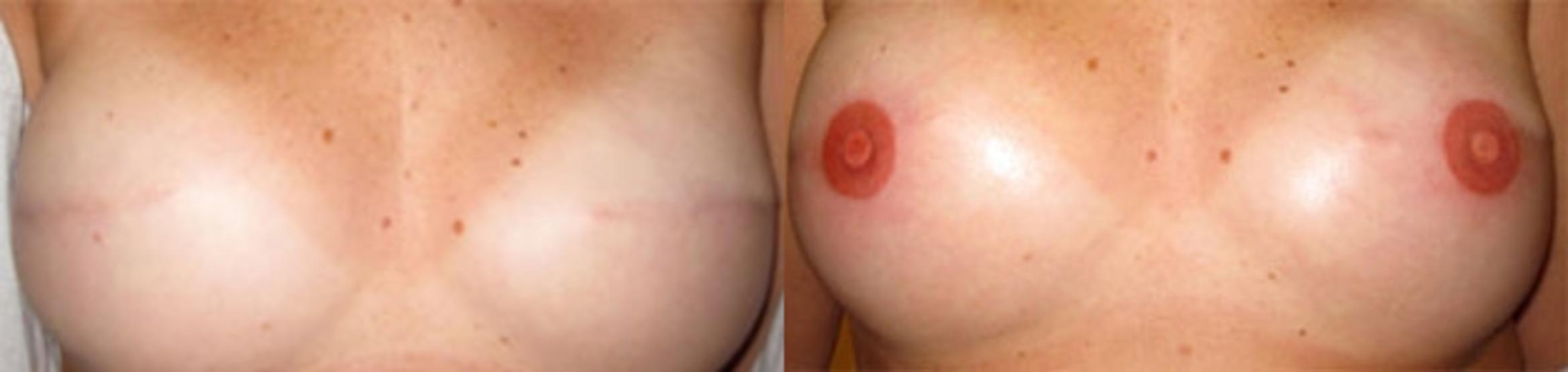 Before & After Scar Camouflage Tattooing Case 1 Front View in Denver, Colorado