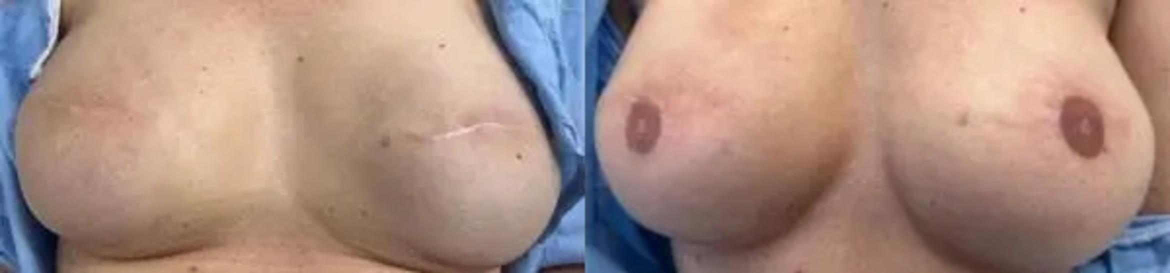 Before & After Scar Camouflage Tattooing Case 15 Front View in Denver, Colorado