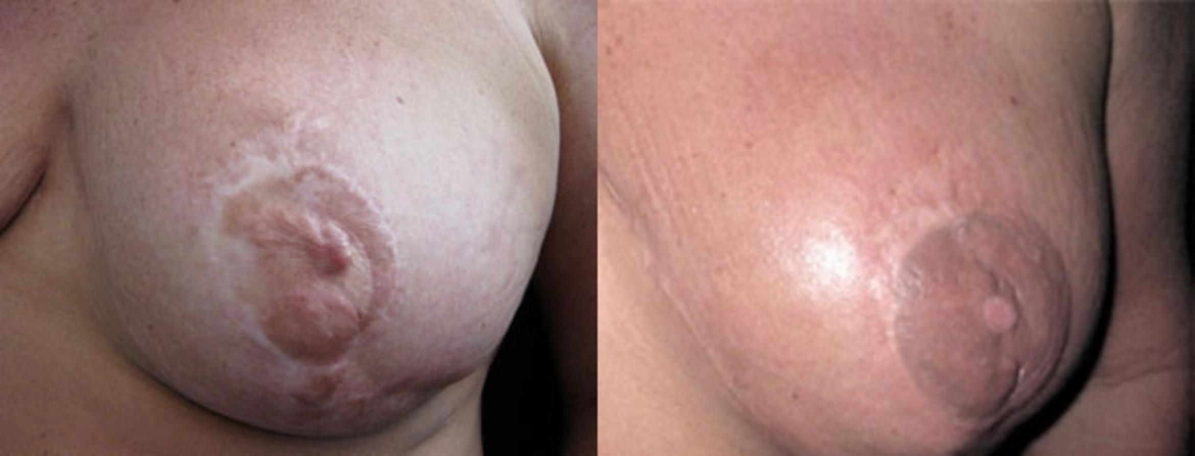 Before & After Scar Camouflage Tattooing Case 8 Front View in Denver, Colorado
