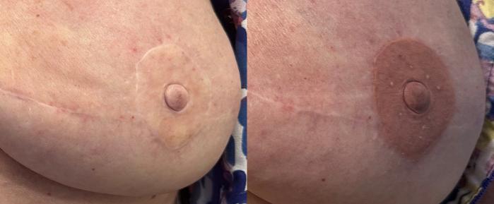 Before & After Unilateral Areola Tattooing Case 23 Left Side View in Denver, Colorado