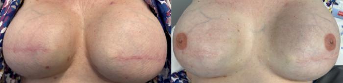 Before & After 3D Areola Tattooing Case 26 Left Side View in Denver, Colorado