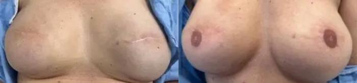 Before & After Scar Camouflage Tattooing Case 15 Front View in Denver, Colorado